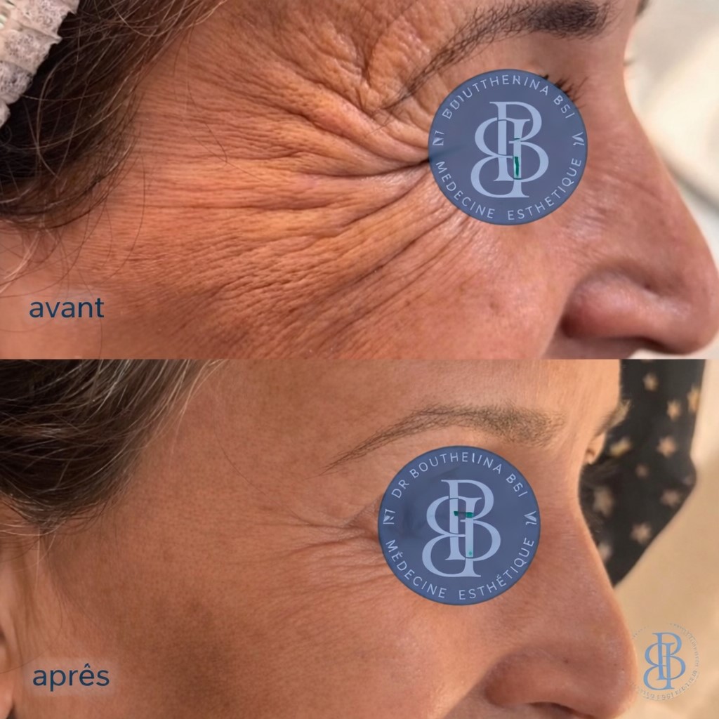 Botox
