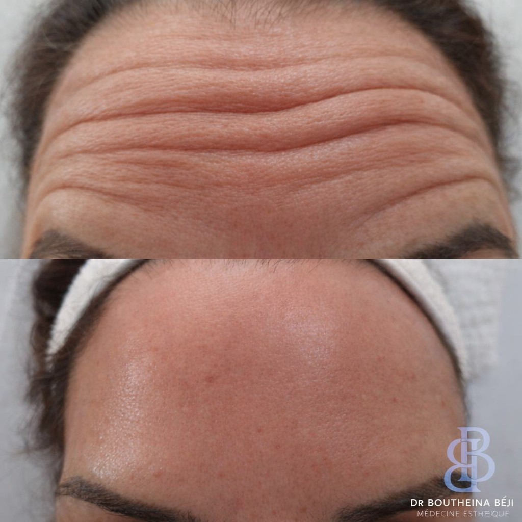 Botox