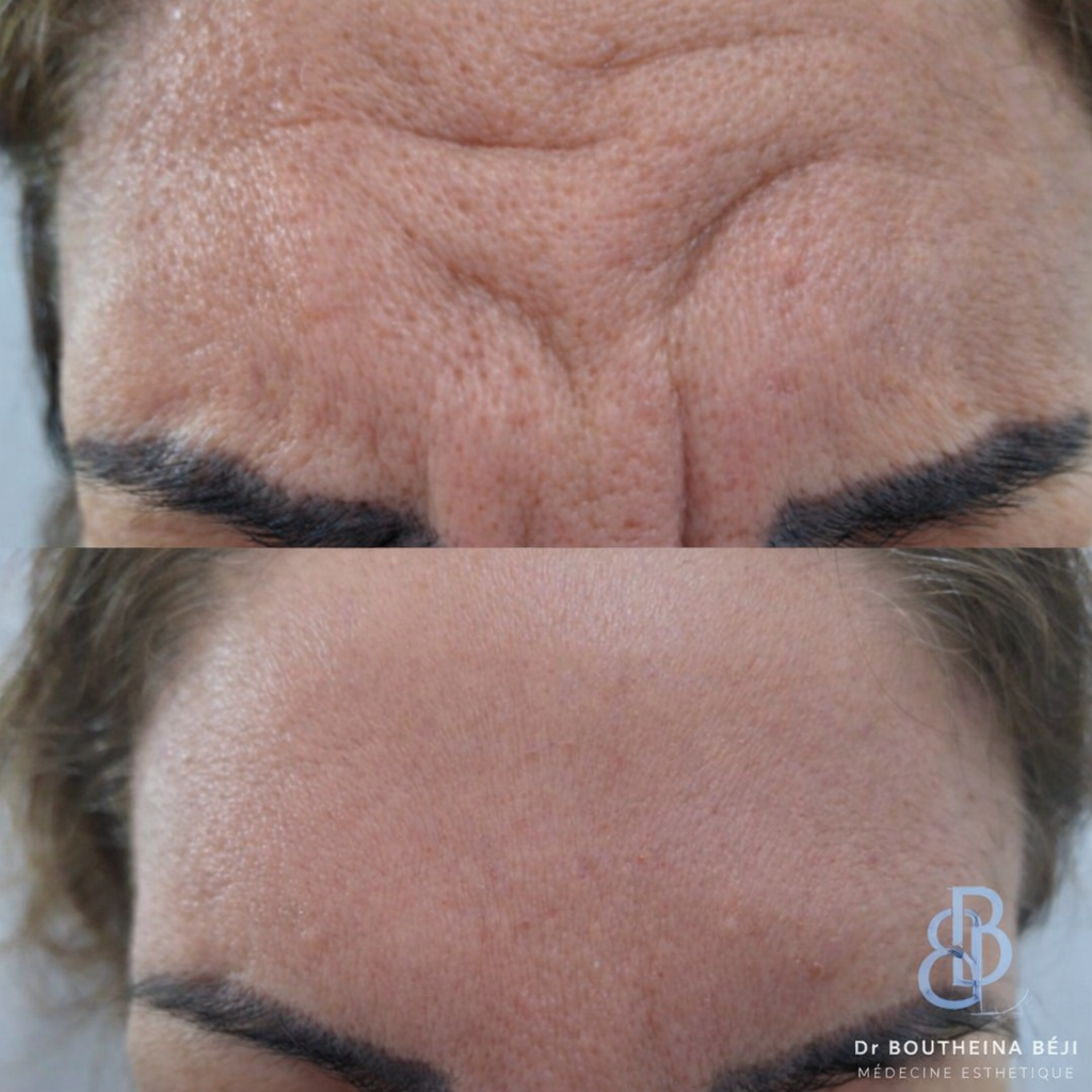 Botox