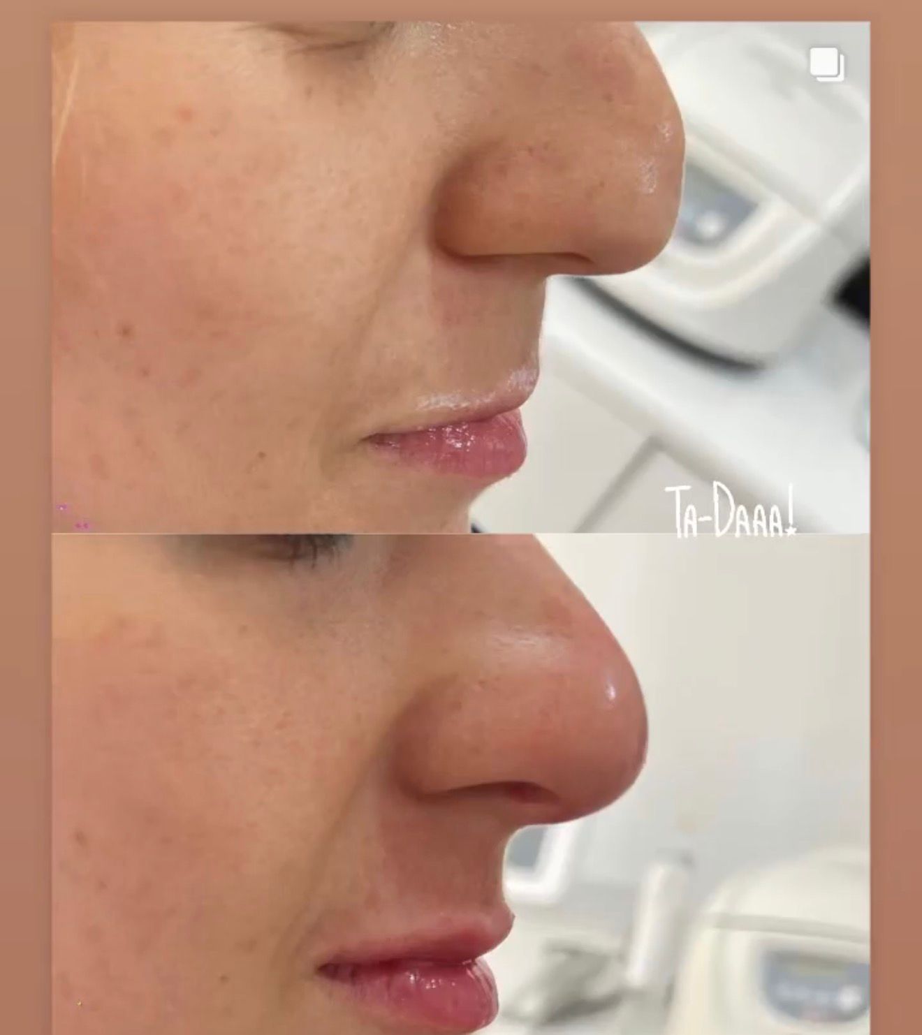 Rhinoplastie Médicale