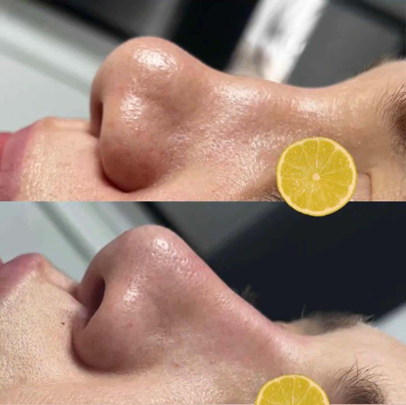 Rhinoplastie Médicale