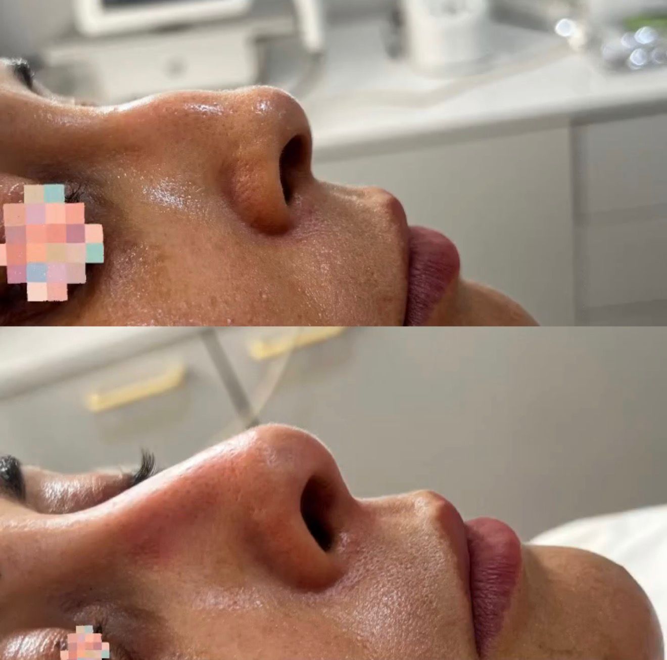Rhinoplastie Médicale