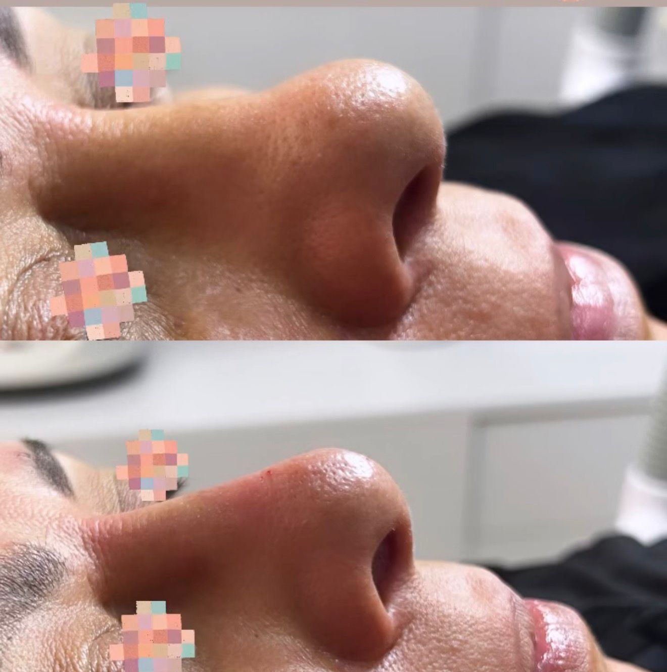 Rhinoplastie Médicale