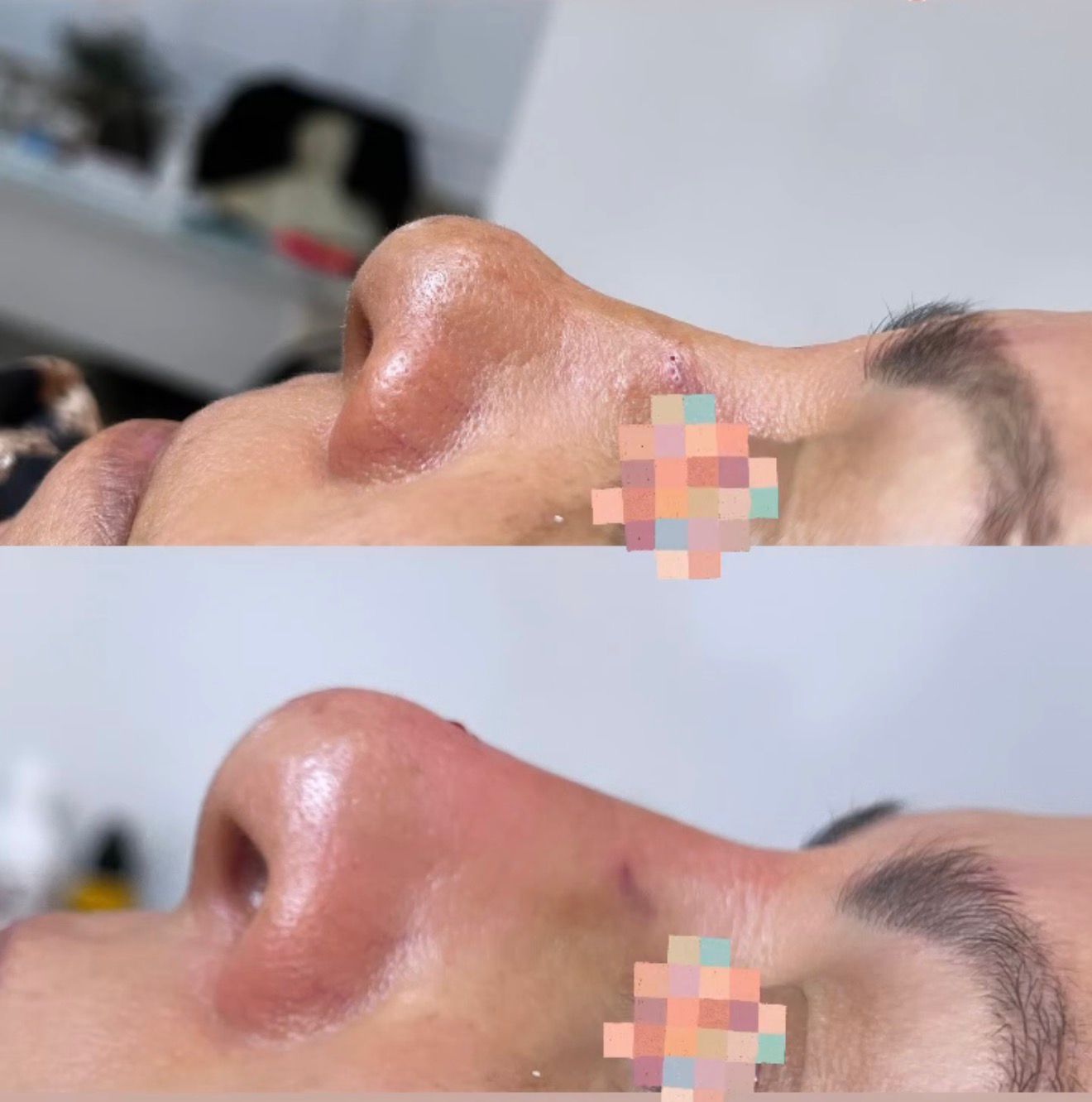 Rhinoplastie Médicale