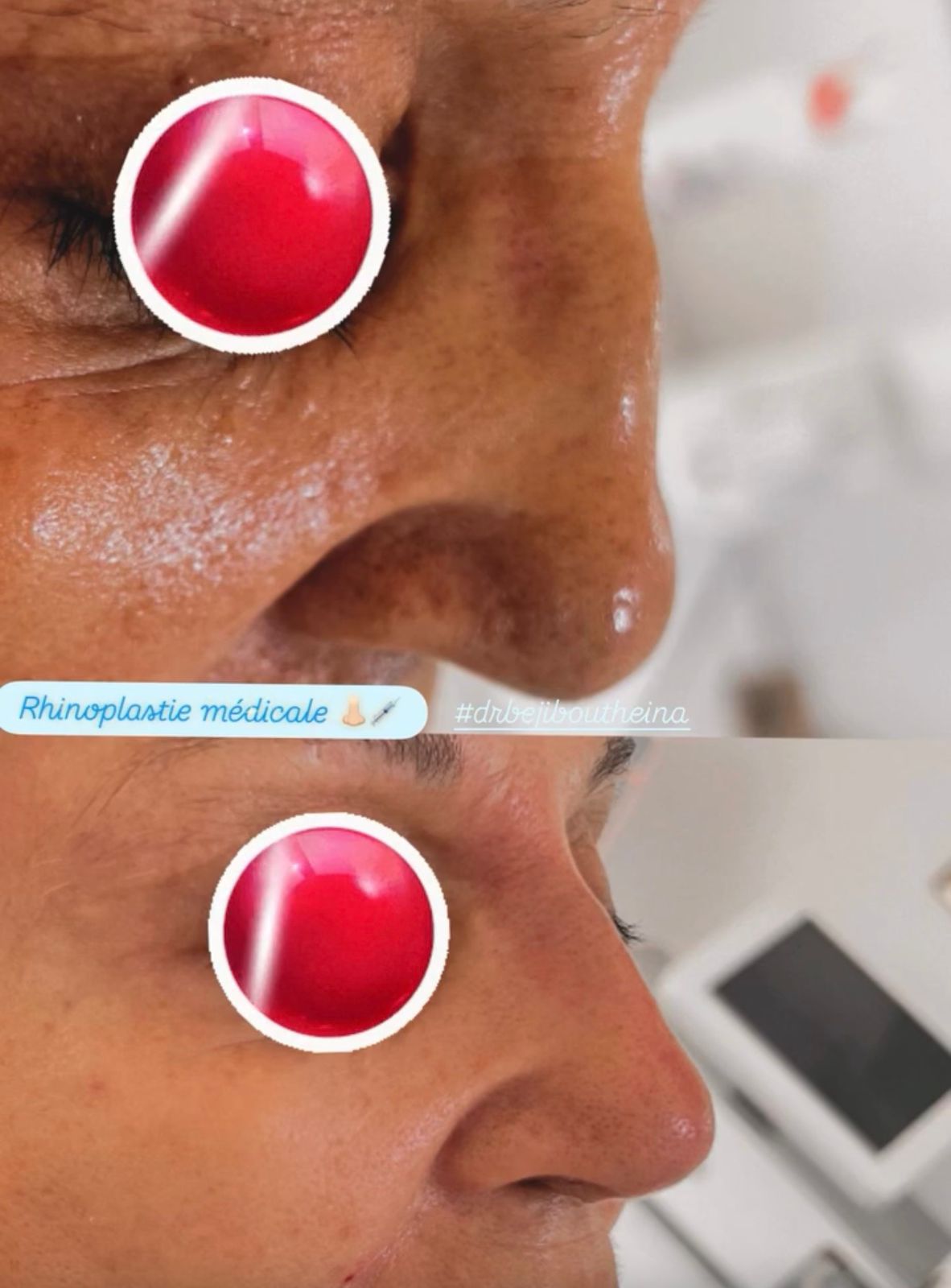 Rhinoplastie Médicale